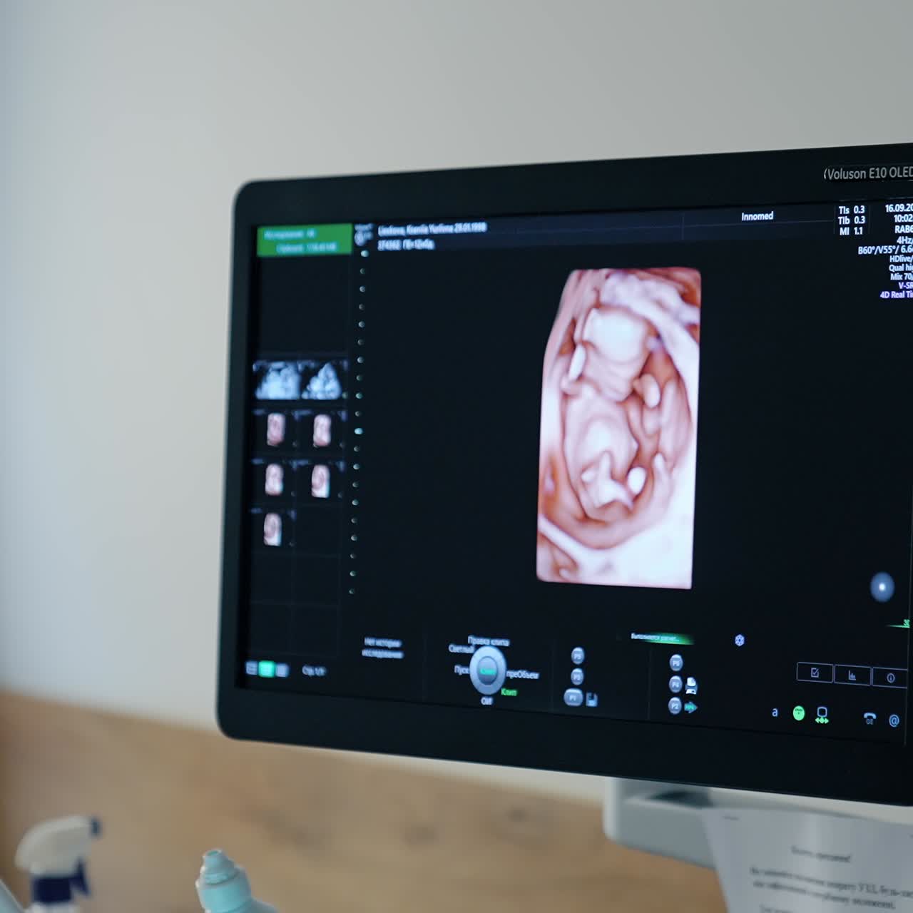 Monitor nero con immagine di un feto. Apparecchiatura per ecografie per la diagnostica di gravidanza