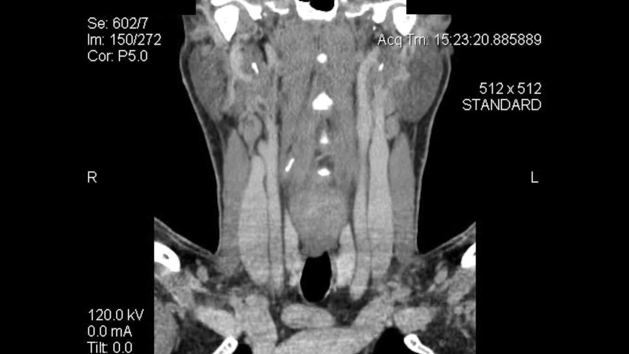 tomografía de plano coronal frontal: capas de tomografía computarizada de la parte inferior de la cara y el cuello