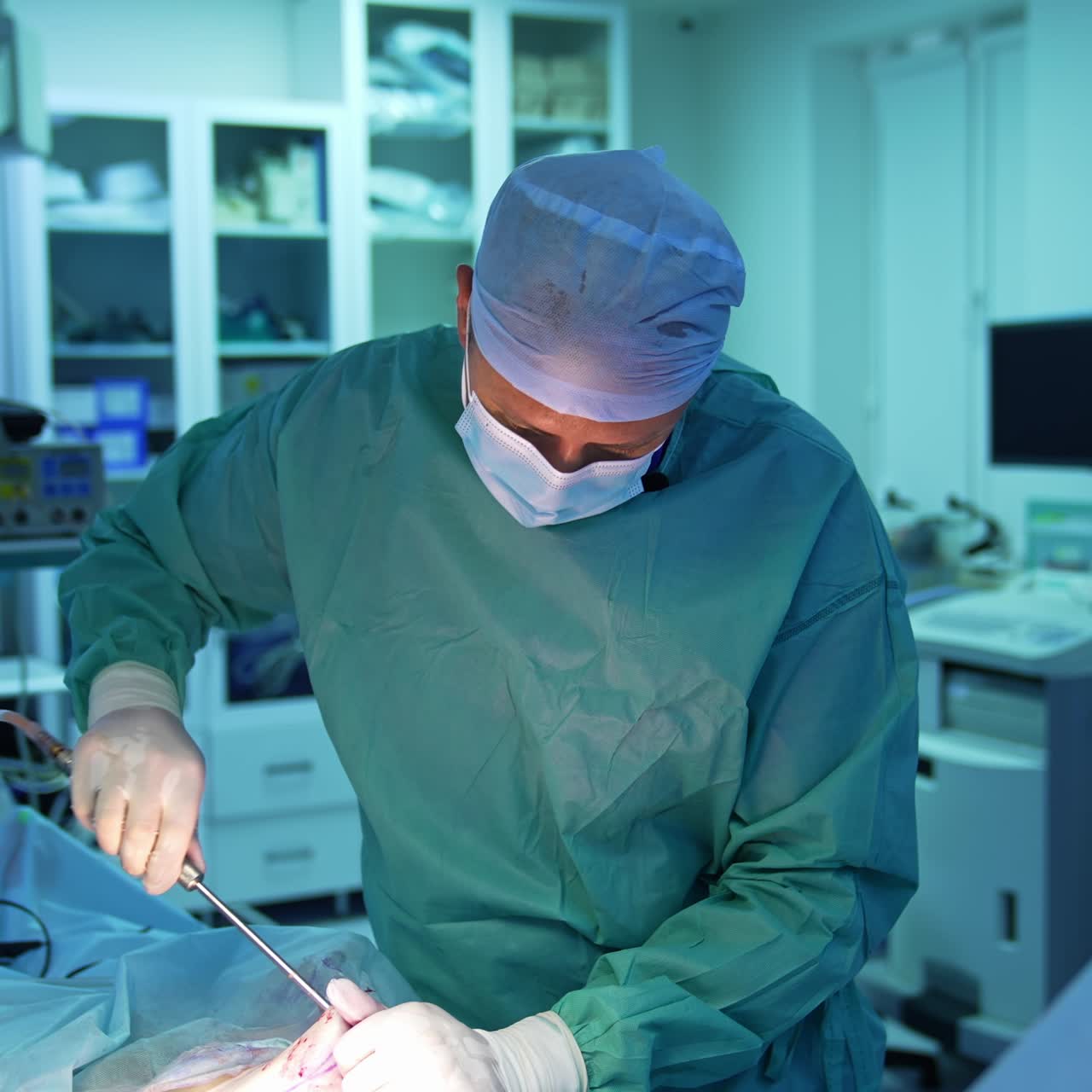 Medico che esegue una procedura medica per l'aspirazione del grasso. Il chirurgo aspira il grasso dall'addome del paziente con uno strumento speciale in sala operatoria.