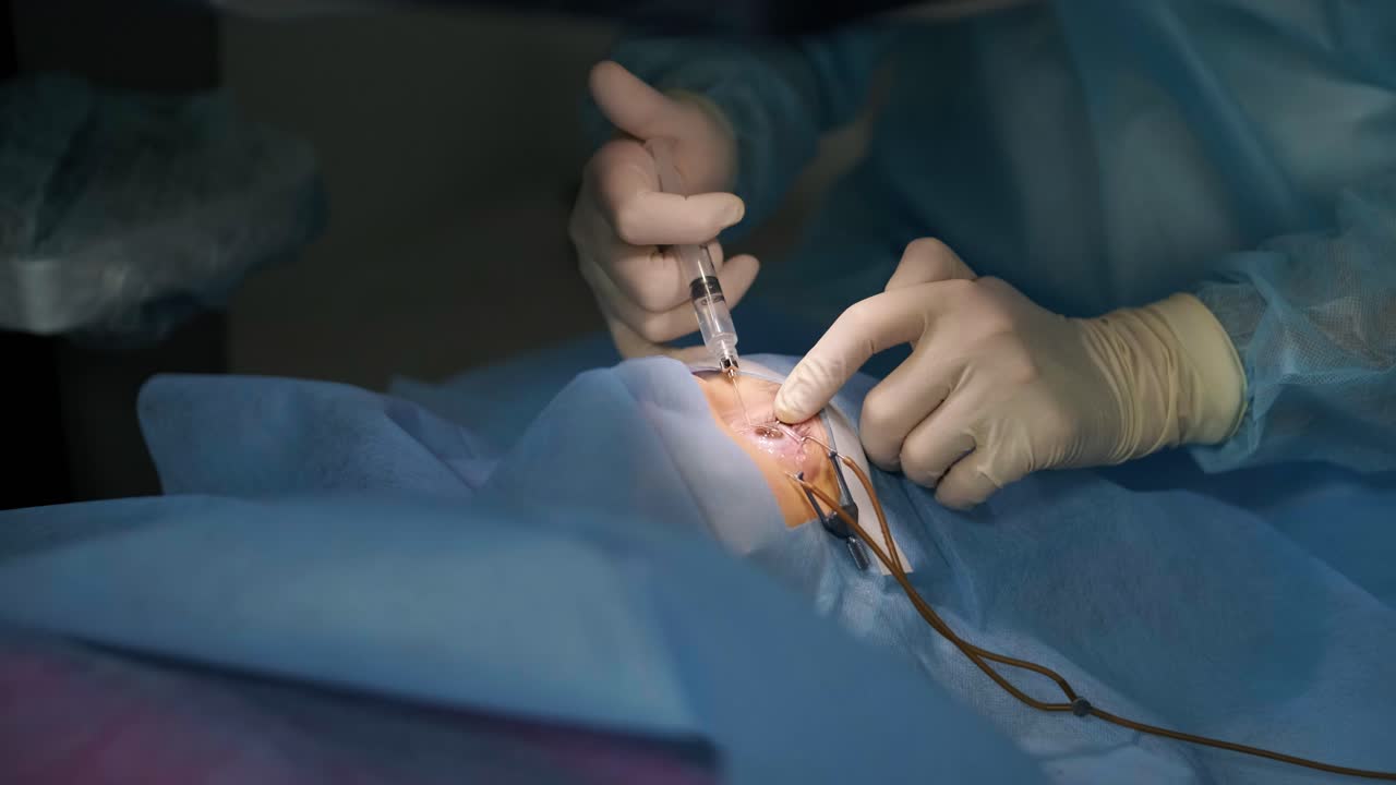 corrección de la visión con láser. un paciente y un equipo de cirujanos en la sala de operaciones durante una cirugía oftalmológica