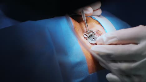 corrección de la visión con láser. un paciente y un equipo de cirujanos en la sala de operaciones durante una cirugía oftalmológica. especulo del párpado. tratamiento de lasik. paciente bajo una cubierta estéril