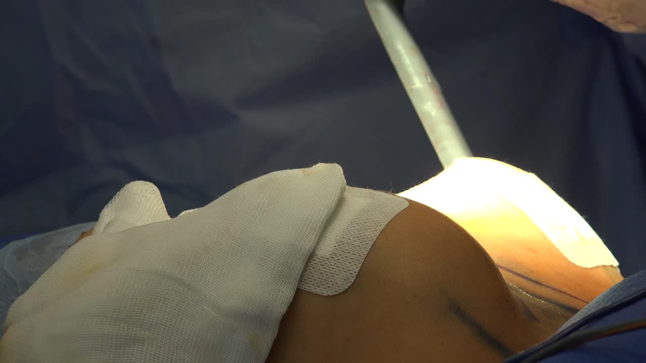 el aumento de senos son términos de cirugía plástica para los métodos de implante mamario y mamoplastía con injerto de grasa utilizados para aumentar el tamaño y alterar la textura de los senos de una mujer.