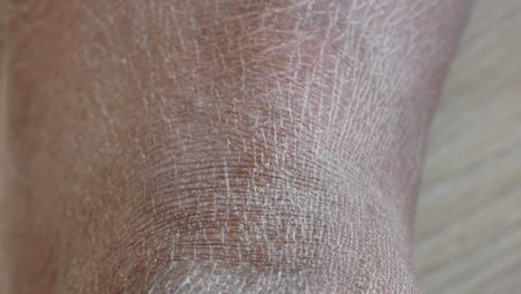 close-up of dry, cracked skin on a person's ankle