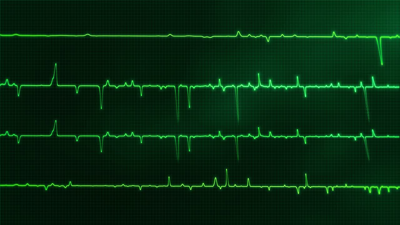 Animação de Monitor de Batimentos Cardíacos ECG, Eletrocardiograma Médico, Loop de Fundo de Sinais Vitais