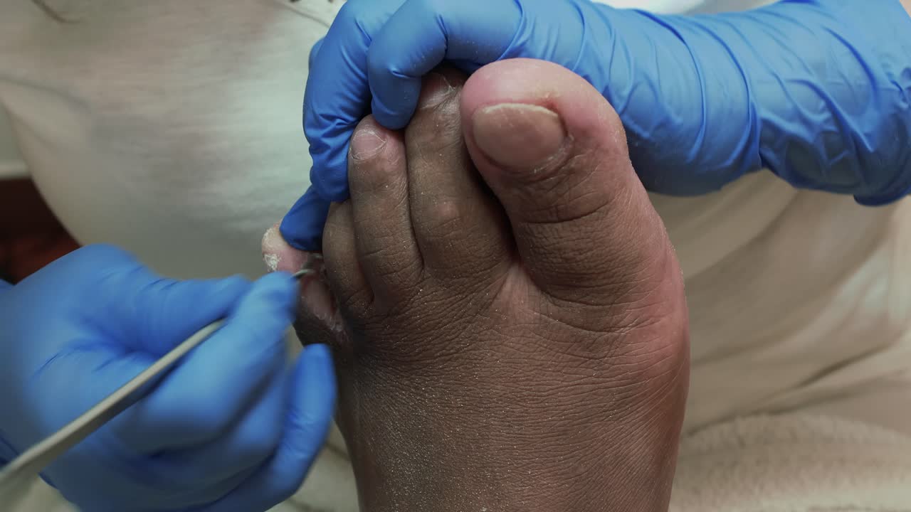 Podologia: raschiatura della pelle morta tra le dita del piede sinistro.