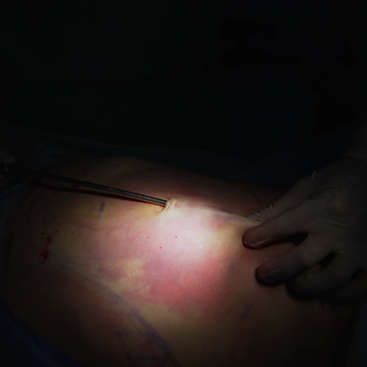 Surgical procedure for pumping fat. Abdominoplasty with surgical tools for collecting fat. Patient's belly during surgery in light. Close-up