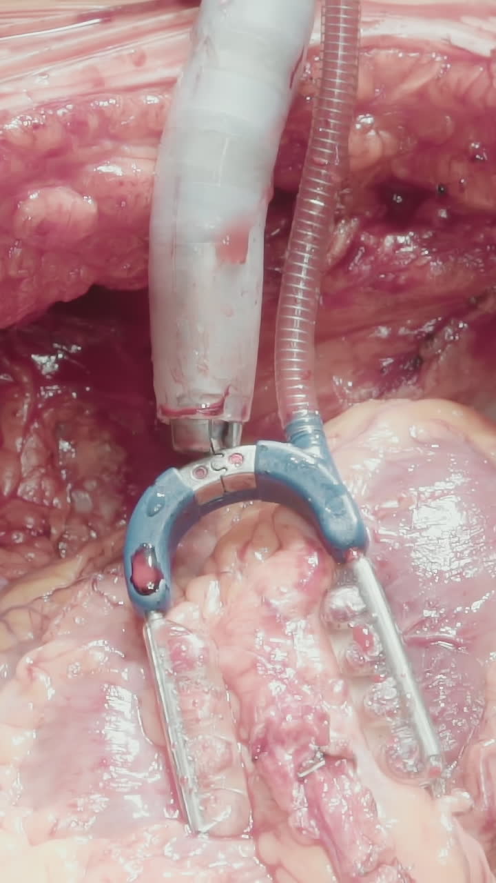 los retractores abren la cavidad torácica para la cirugía. las cuchillas metálicas correctamente posicionadas proporcionan al cirujano acceso al órgano creando condiciones operativas óptimas