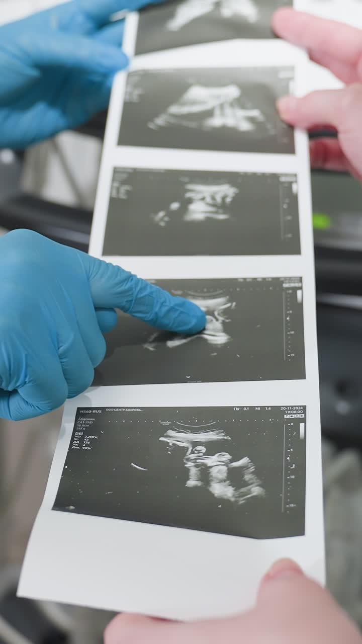 gloved technician pointing at ultrasound prints with white patient visible, closeup of thermal film strip as clinician finger indicates fetal features, black and white image detail, sterile blue