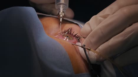 laser vision correction. a patient and team of surgeons in the operating room during ophthalmic surgery. eyelid speculum. lasik treatment. patient under sterile cover