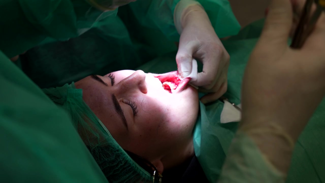 Il chirurgo dentale sutura la gengiva in primo piano durante un intenso intervento chirurgico orale.