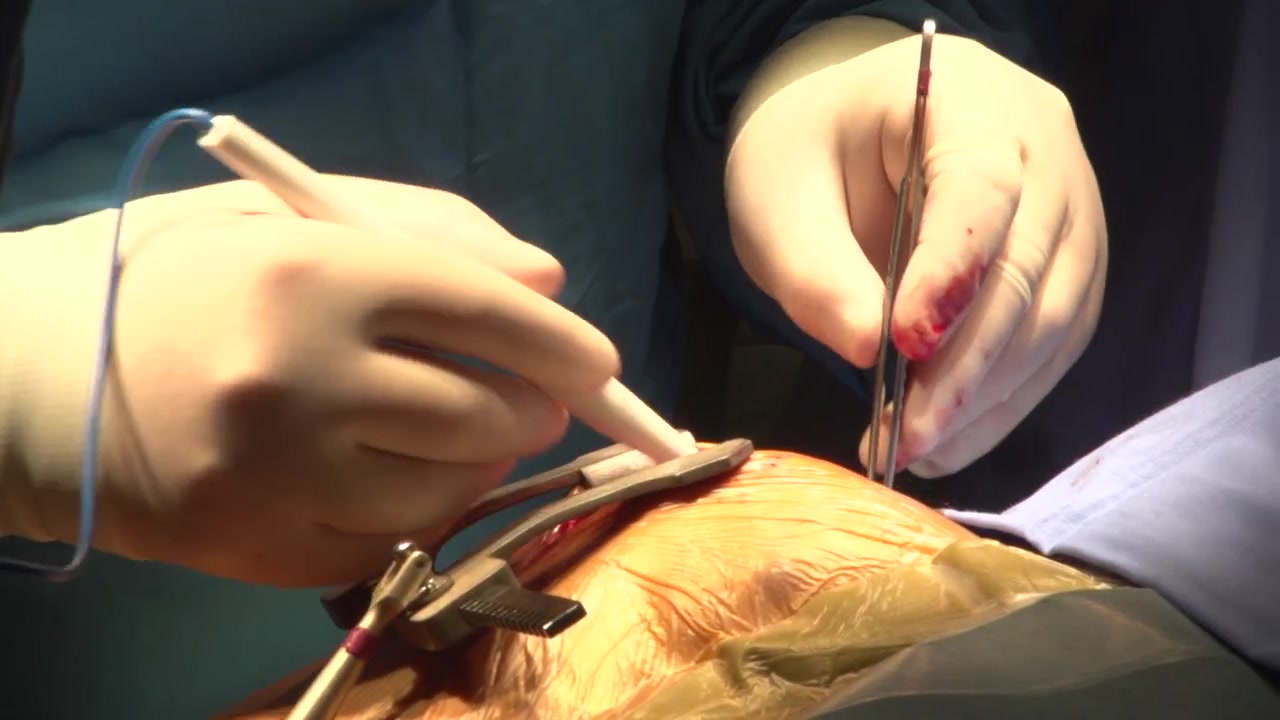 Inquadratura ravvicinatissima di un chirurgo con guanti sterili che utilizza una penna cauterizzatrice elettrochirurgica e pinze mediche su un sito di incisione tenuto aperto da divaricatori durante un'operazione in una sala operatoria.