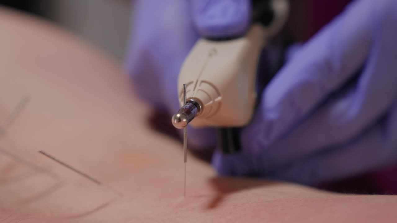 Precision electrostim needle therapy tool targets back muscle during dry needling