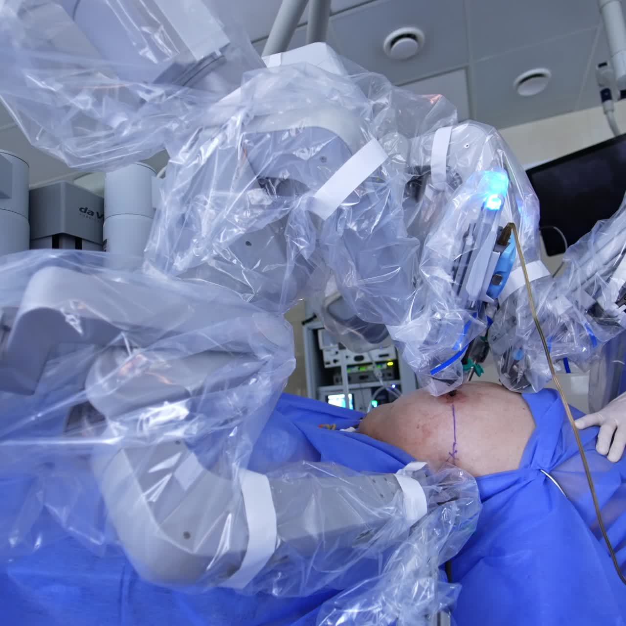Big belly of a patient is operated by the robot surgeon. Technological arms move in the little openings. Surgeon controlling the process. Low angle view