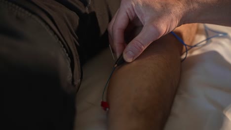 médico que aplica abrazaderas de electrodos a las agujas en el brazo del paciente durante la sesión de electroacupuntura