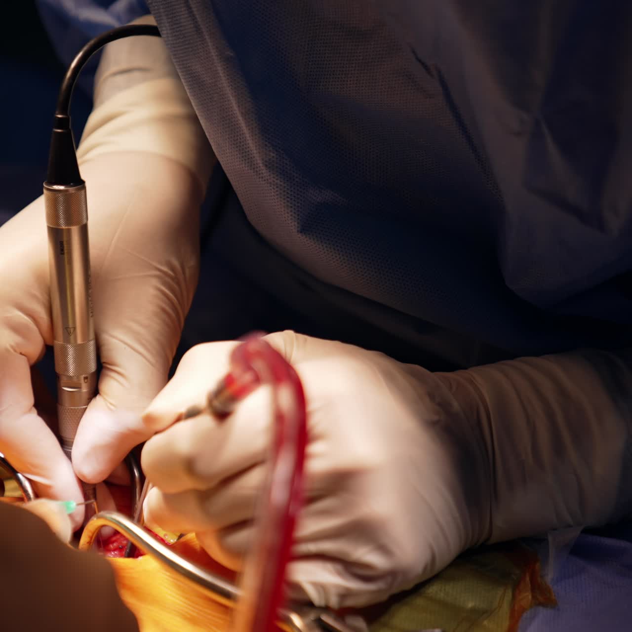 Due mani di un medico con guanti in lattice che tengono gli strumenti. Neurochirurgia eseguita da un team medico. Primo piano