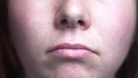 close-up of a person's mouth with a cold sore