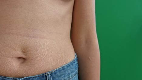 close up on woman belly with stretch marks on the skin after child birth