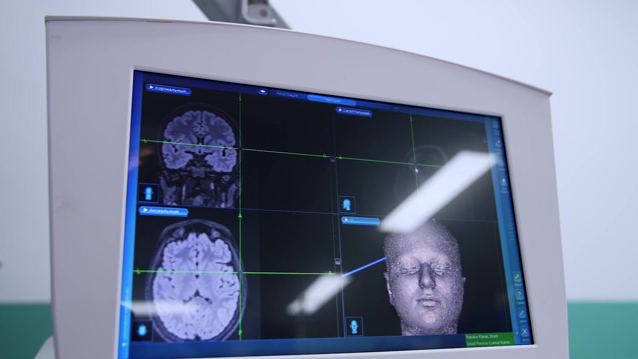 Imágenes 3D de la cabeza y el cerebro del paciente. Monitor con escaneo de resonancia magnética en operación neuroquirúrgica. Cirugía de tumores. Primer plano.