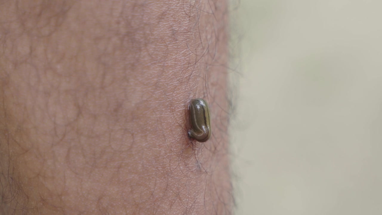 A leech has latched onto a person.
