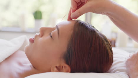 beautician or masseuse placing acupuncture needles