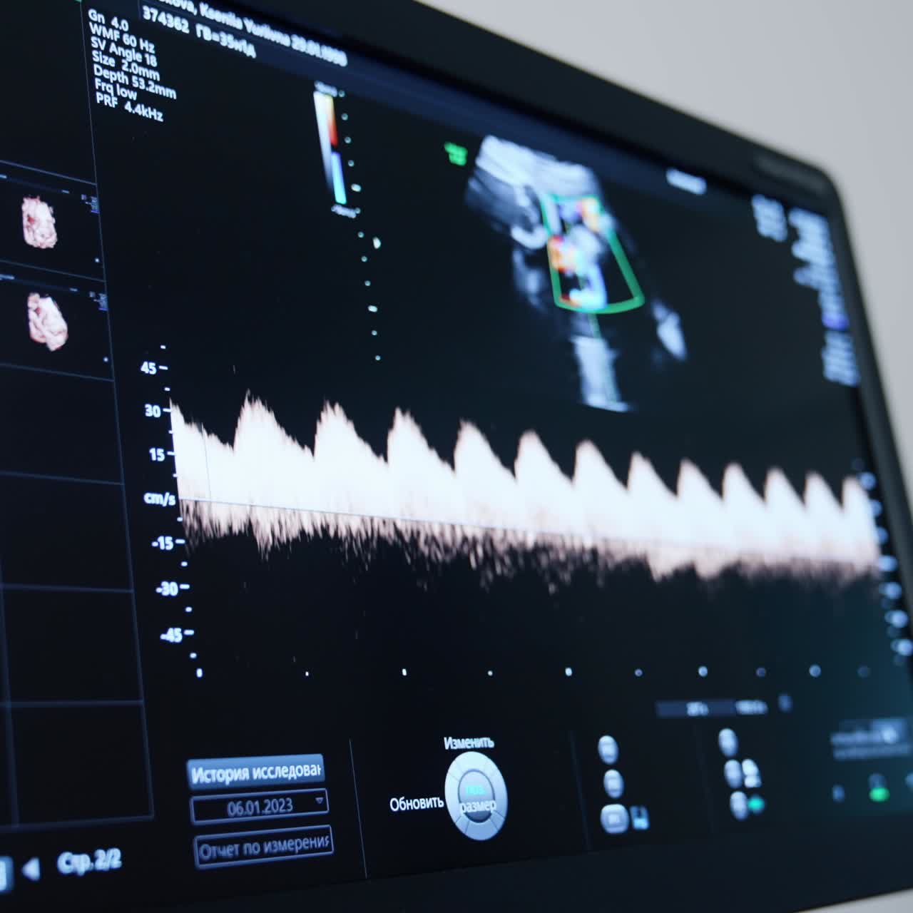 Heartbeat rate line shown on the screen of ultrasound machine. Close up. Pregnancy examination in the hospital