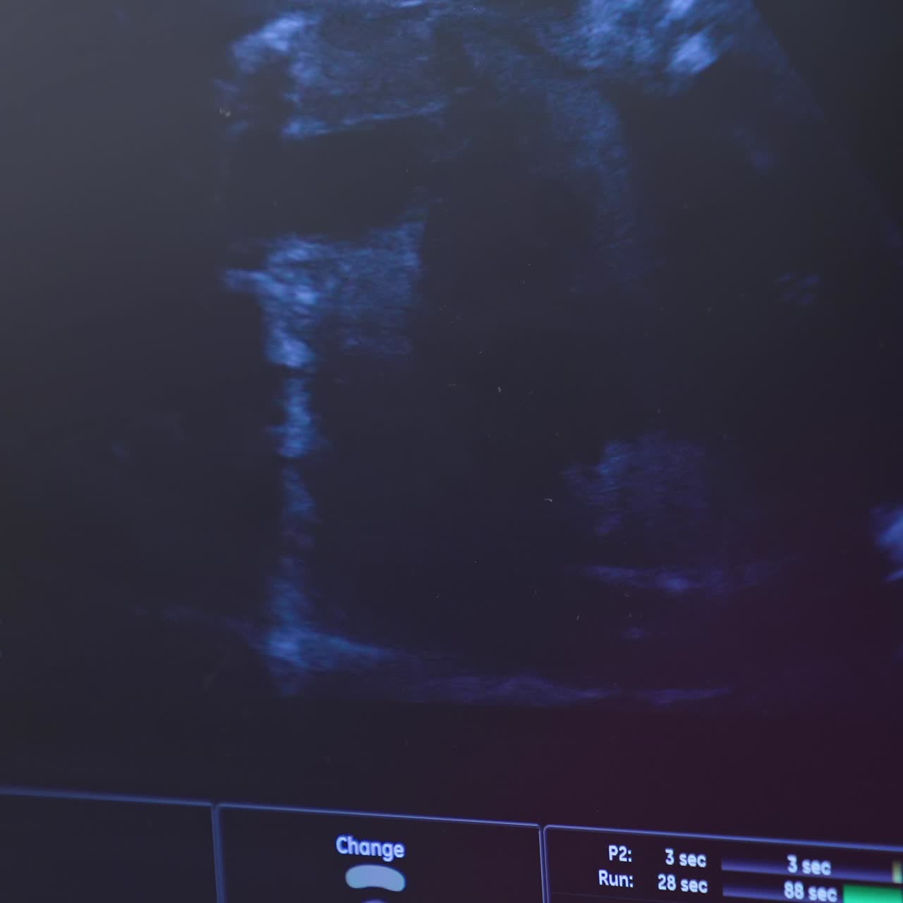 Dynamic ultrasound image of an embryo on screen. Tiny baby is turning in mother's belly. Baby in mother's womb is moving during sonography. Close-up