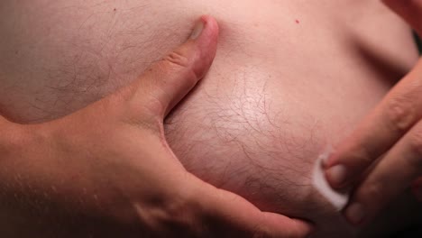 primer plano de la limpieza del abdomen con una toallita higiénica húmeda en preparación para la autoaplicación del medicamento a través de una pluma de aguja médica inyectando la sustancia en una zona grasa del vientre