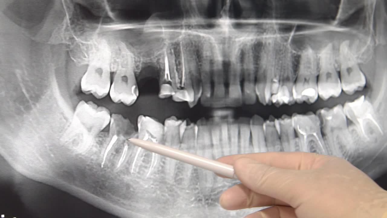 Dental X-Ray Panoramic View