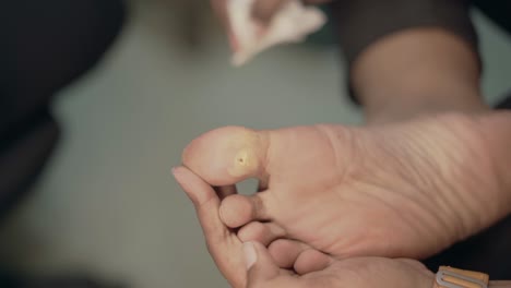 common wart  on leg closeup view