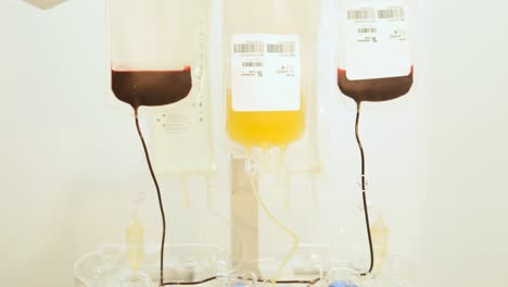 Dialysis-machine-working-in-hospital-Blood-flow