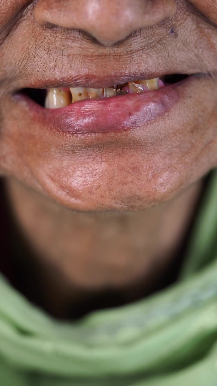 Anziano che sorride, mostrando denti rovinati