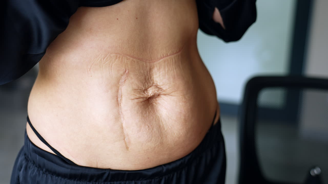 Loose wrinkled extra skin on the belly of unrecognized woman. Male hands check the area for future plastic surgery.