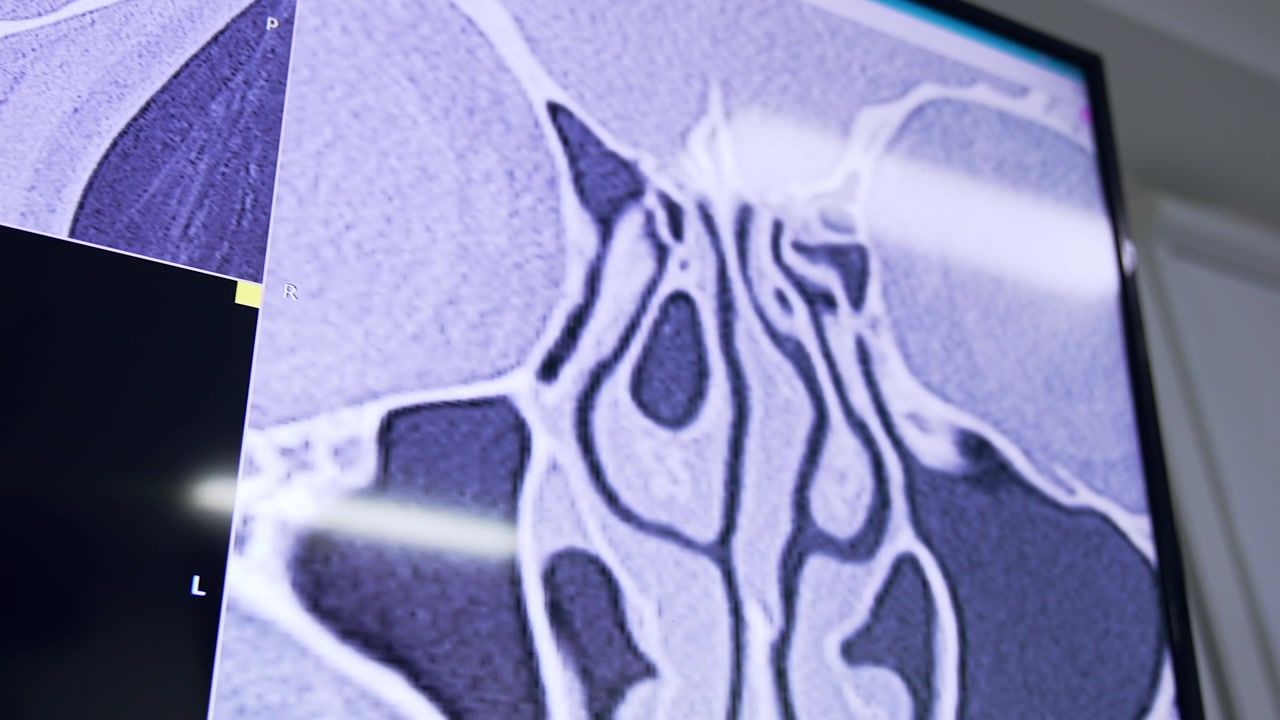 Radiografia da cabeça de um paciente. Detalhe. Cirurgia da cavidade nasal em clínicas modernas.