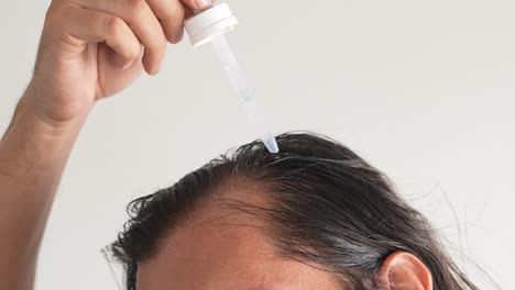 Mann,-Der-Minoxidil-Mit-Einer-Pipette-Ins-Haar-Einträgt,-Kahlheit