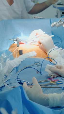 un equipo de cirujanos realiza una cirugía cardíaca en la clínica. los médicos operan al paciente con equipos modernos durante el procedimiento de derivación de la arteria coronaria en la habitación