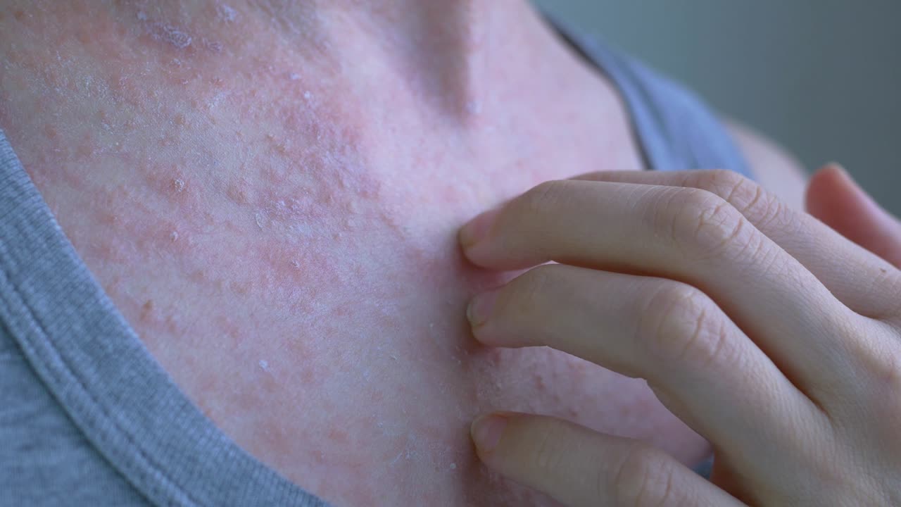 여성의 몸의 개방된 부위에서 알레르기 반응은 분홍색 발진으로 여 있습니다. 손으로 염증에서 건조한 필름을 제거합니다. 바이러스 질병. 근접
