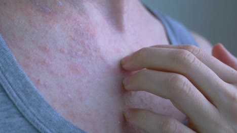 en un área abierta del cuerpo de la mujer, una reacción alérgica se vierte en una erupción rosada. con las uñas, quitar la película seca de la inflamación. enfermedades virales. primer plano
