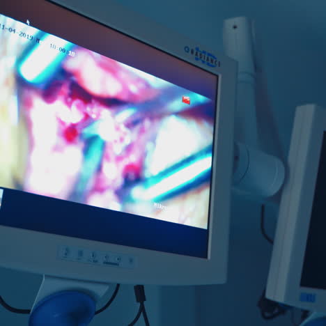 close-up neurosurgery on the monitor. modern technologies during operation. process of surgery on the screen of contemporary equipment in the hospital.