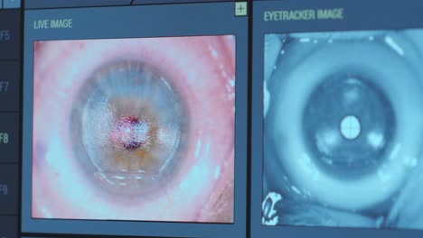 ophthalmic surgery. view on the screen of medical monitor in operating room. lasik