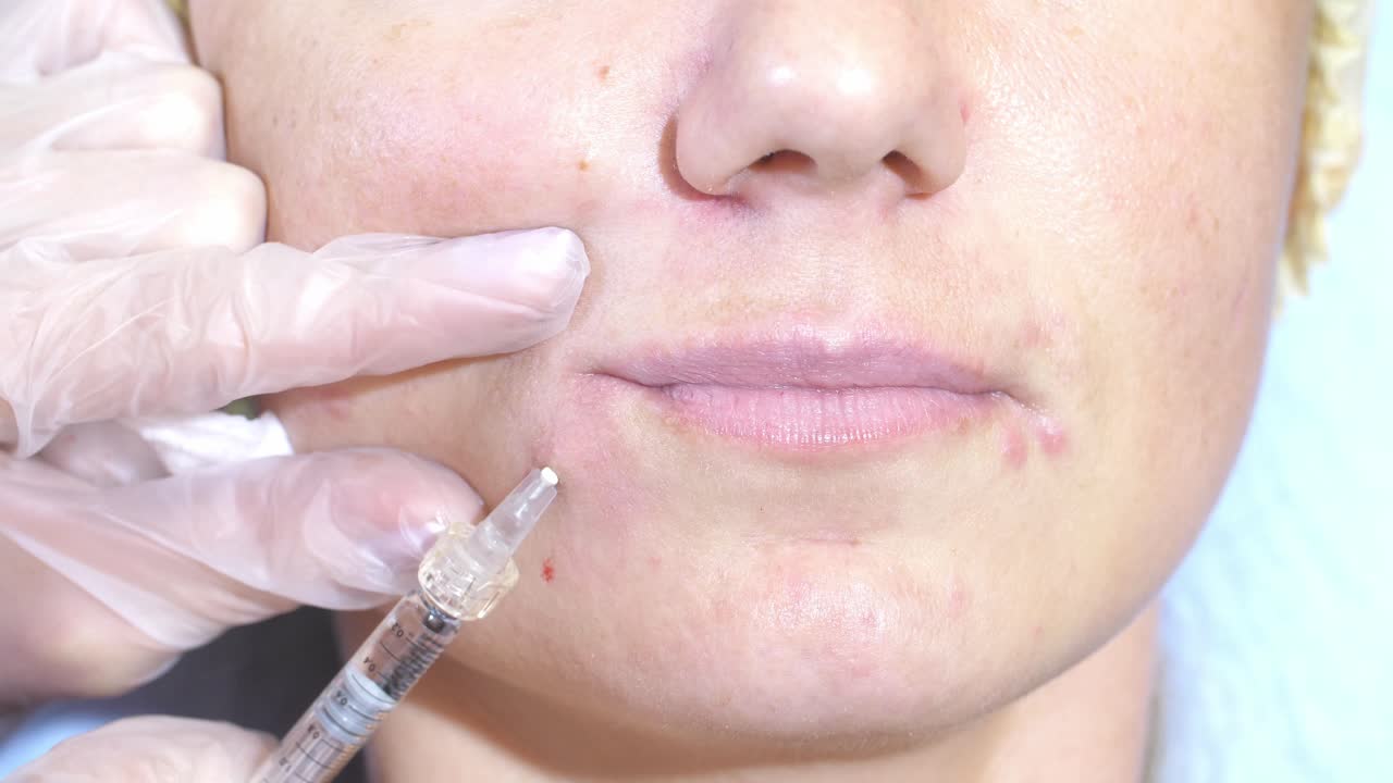 procedimiento de inyecciones faciales