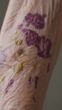 aged skin with lesions