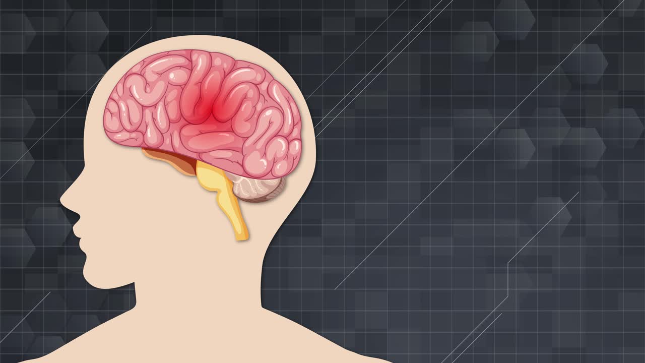 Animation illustrates atherosclerosis development in brain arteries, highlighting plaque buildup and blood flow obstruction