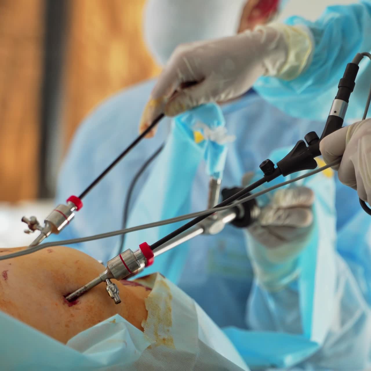 Surgeons hands during surgery