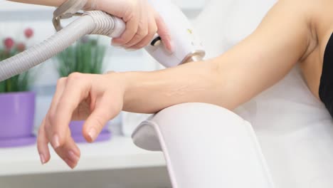 laser hair removal treatment
