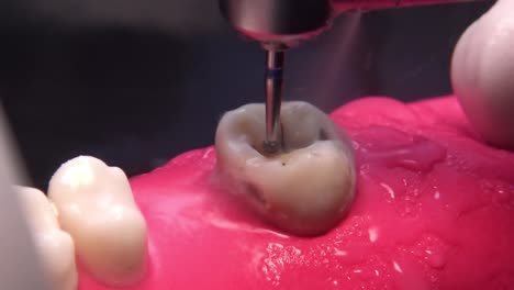 molar tooth dental caries removal with contra angle handpiece rosehead bur, close up