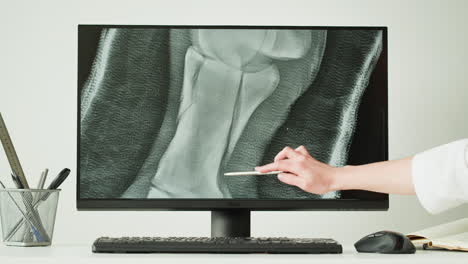 medical x-ray of a knee injury