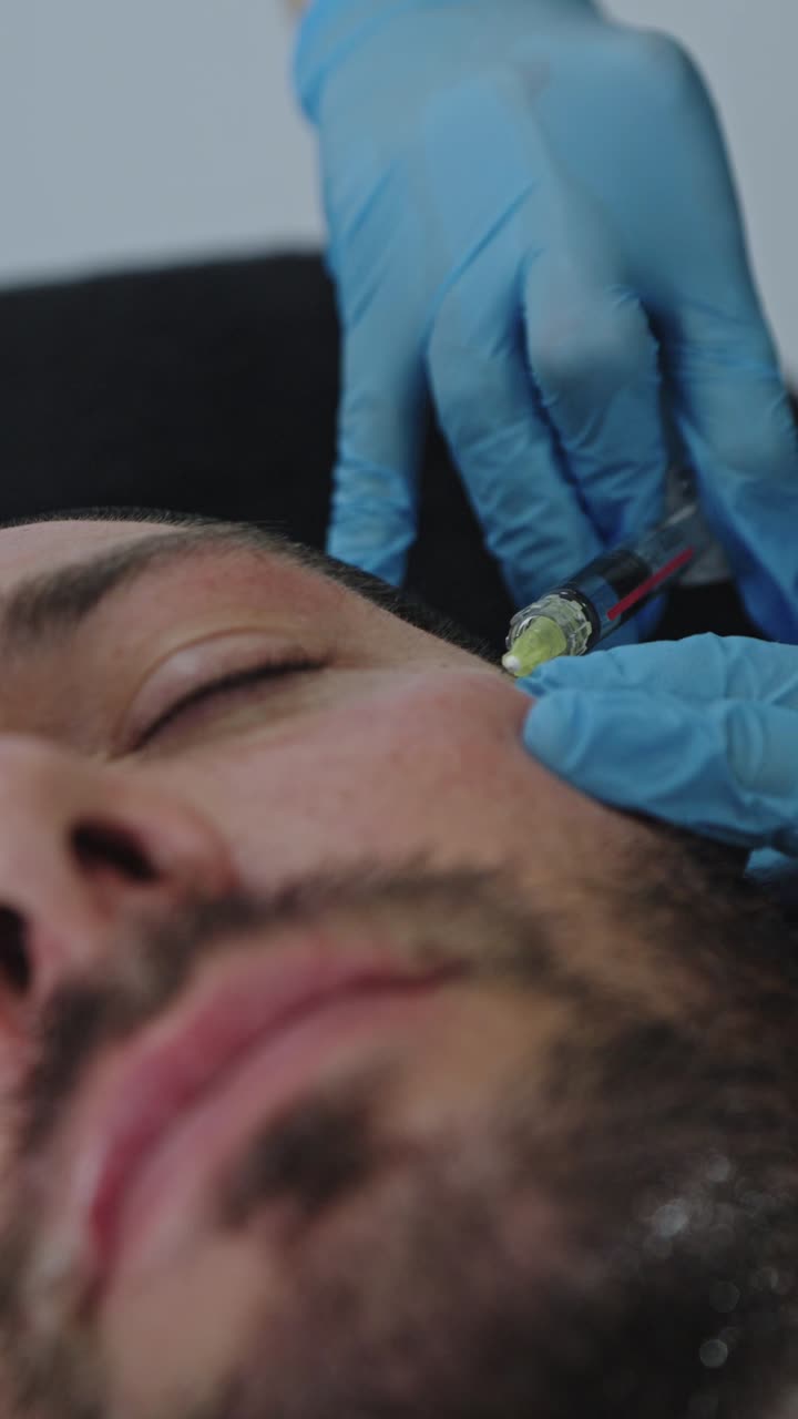 Questo primo piano cattura un medico specializzato in medicina estetica, mentre esegue una precisa iniezione intradermica di polinucleotidi su un paziente di sesso maschile.