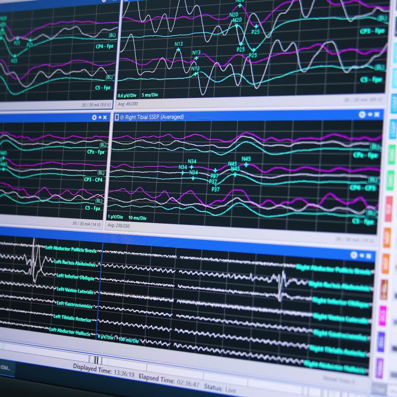 Parametri neurochirurgici sul monitor. Primo piano. Apparecchiatura di neuromonitoraggio in sala operatoria. Primo piano