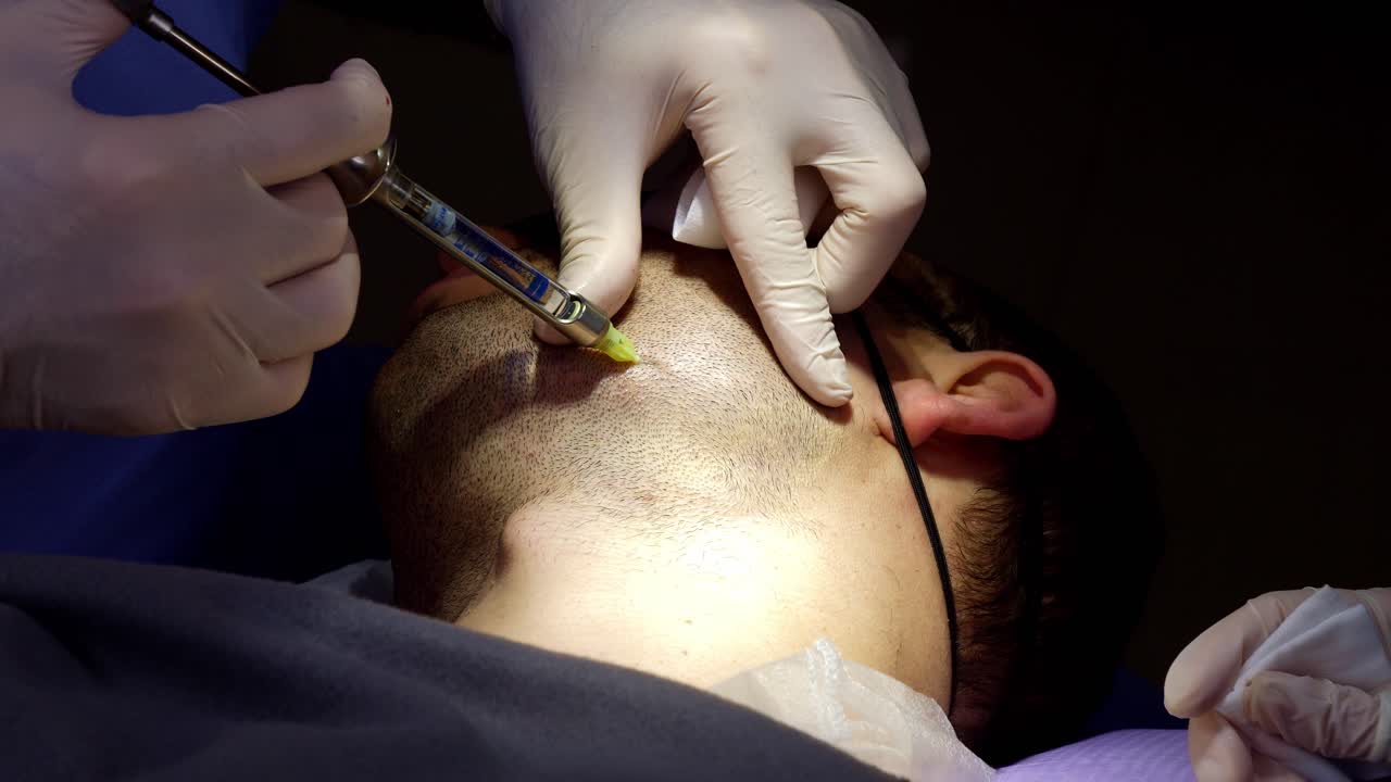 Paziente che si prepara per un trapianto di barba con iniezione anestetica sottocutanea.