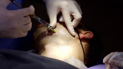 patient getting prepared for beard harvesting transplant with subcutaneous numbing injection